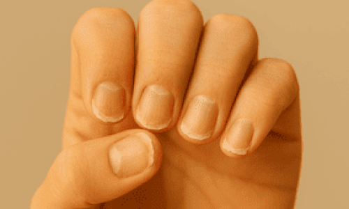 Primer plano de una mano levantada con los dedos ligeramente curvados hacia adentro, mostrando claramente cinco uñas visiblemente dañadas. Las uñas están opacas, deshidratadas y presentan bordes irregulares, con capas levantadas y signos evidentes de fragilidad. Esta imagen representa de forma realista el aspecto típico de unas uñas frágiles, ideales para ilustrar el tema ¿Cómo fortalecer las uñas débiles y quebradizas de forma natural?, destacando la importancia del cuidado y la nutrición adecuada para mejorar su salud.









