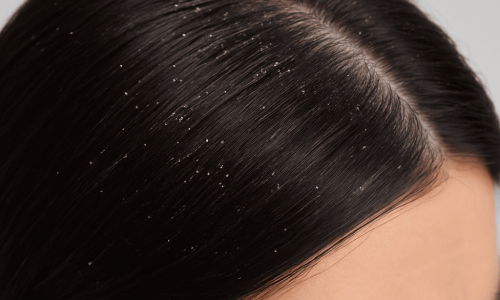 Primer plano de un cuero cabelludo con cabello oscuro lleno de escamas blancas visibles, típicas de la caspa. Las partículas están esparcidas entre las raíces del cabello, mostrando claramente el problema. La expresión del rostro es de incomodidad o preocupación, representando la pregunta clave ¿Qué hago si tengo caspa?

